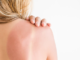 sun-damaged-skin-treatment-home-remedies
