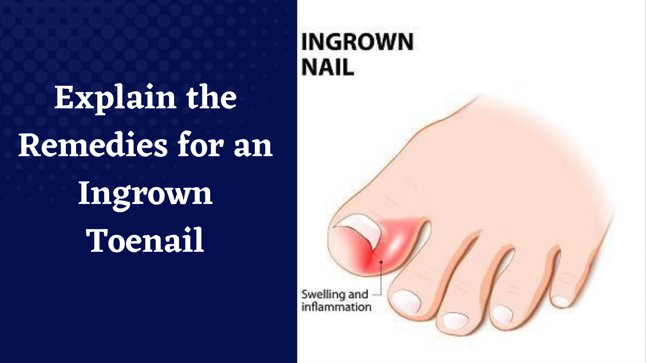 1. Causes and Treatment of Dark Blue Ingrown Hair - wide 6