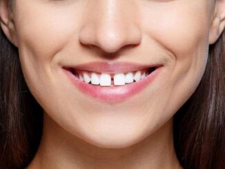 how-to-get-rid-of-a-gap-in-your-teeth