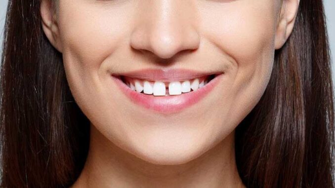 how-to-get-rid-of-a-gap-in-your-teeth