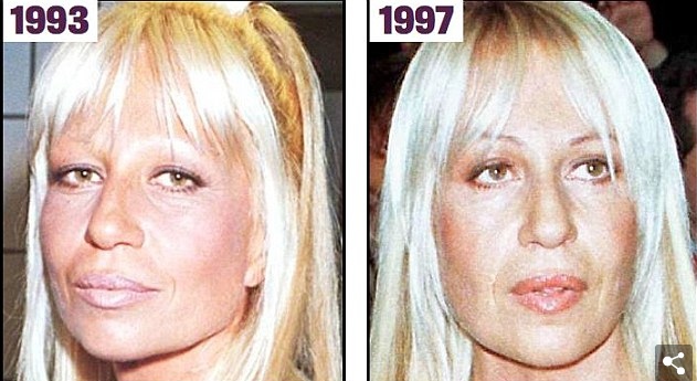 donatella-versace-plastic-surgery