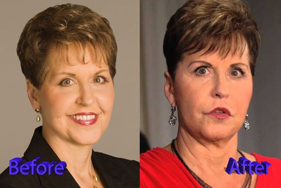 joyce-meyer-plastic-surgery