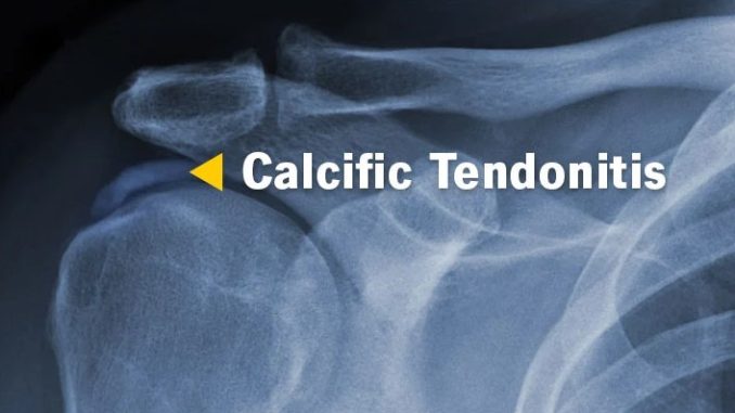foods-for-tendonitis