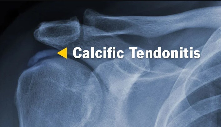 Foods To Avoid With Calcific Tendonitis