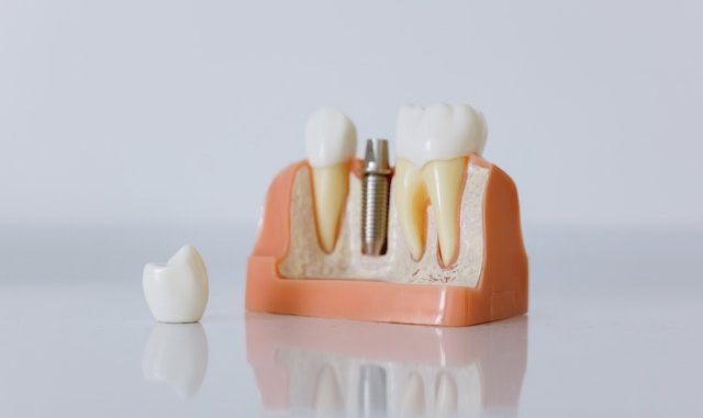 dental-implant-components-treatment