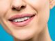 teeth-whitening-solutions-tips-ideas